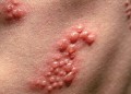 Bệnh Herpes là gì?